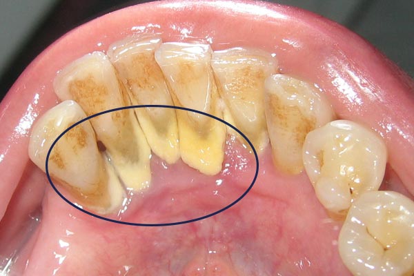 dental calculus